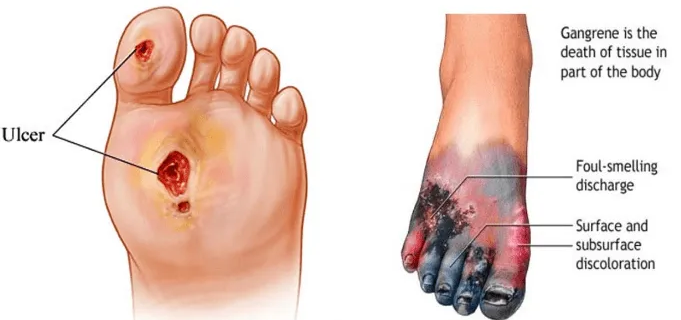 Critical Limb Ischemia: Understanding the Risks and Safeguarding Your Limbs