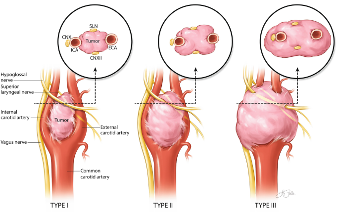 Carotid Body Tumor: Symptoms, Causes & Treatment